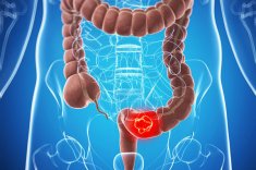 Онкомаркер на рак кишечника