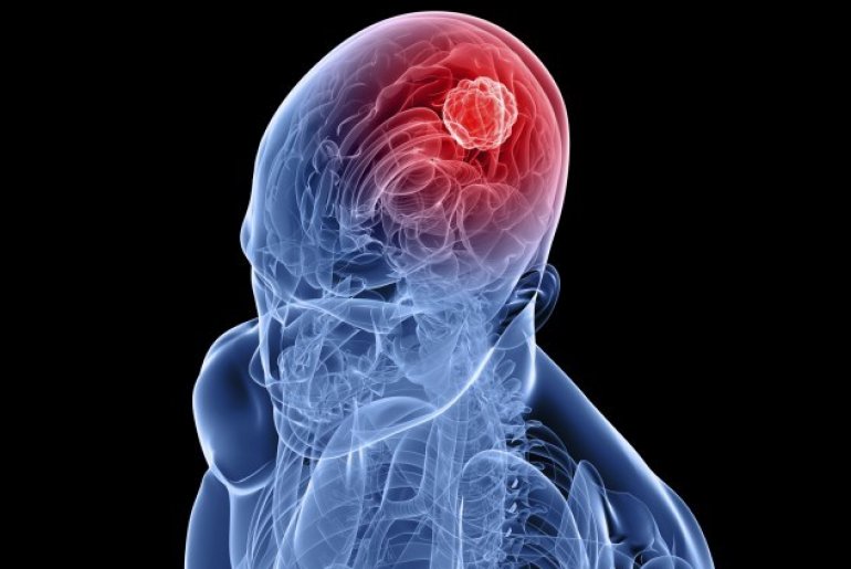 Признаки и лечение рака головного мозга