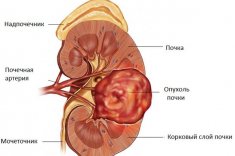 Рак почки, сколько живут после операции