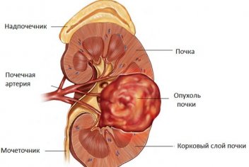 Рак почки, сколько живут после операции - No-onco.ru