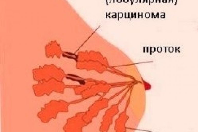 Болезнь рак груди: виды, симптомы, диагностика и лечение