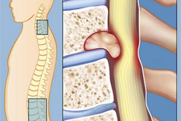 Рак поясничного отдела позвоночника: описание, симптомы и диагностика - No-onco.ru