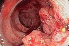 Рак толстого кишечника этиология, клиника, стадии,  патогенез, диагностика, лечение