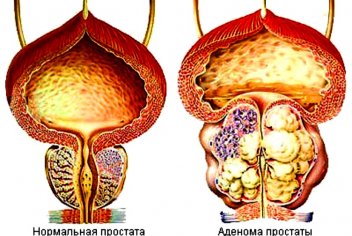 Опухоль предстательной железы - No-onco.ru