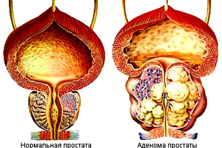 Опухоль предстательной железы