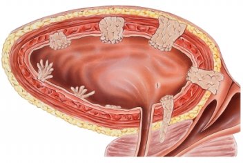 Опухоль мочевого пузыря - No-onco.ru