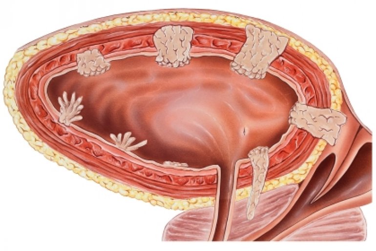 Опухоль мочевого пузыря