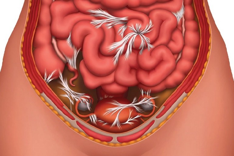 Боли в животе спайки