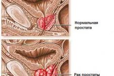 Рак аденомы простаты