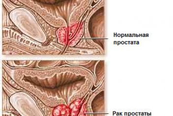 Рак аденомы простаты - No-onco.ru