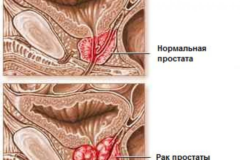 Рак аденомы простаты
