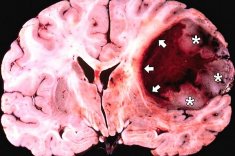Диагностика опухоли головного мозга
