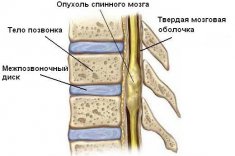 Опухоли спинного мозга