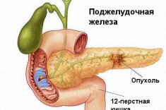 Аденокарцинома поджелудочной железы