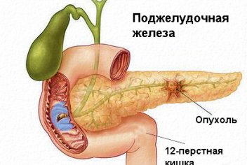 Аденокарцинома поджелудочной железы - No-onco.ru