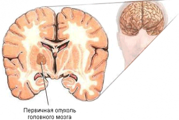 Рак головного мозга: операция, послеоперационный период - No-onco.ru