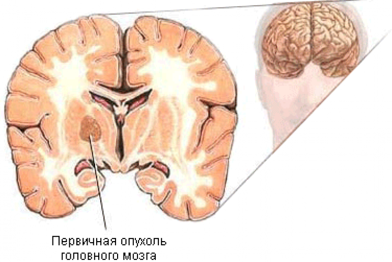 Трепанация черепа при опухоли головного мозга