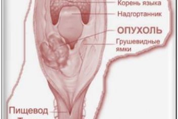 Рак гортани лечение народными средствами: описание, лечение - No-onco.ru