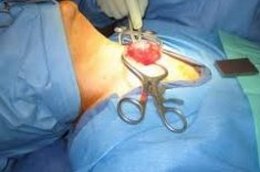 Операции при раке гортани — последствия и восстановление.