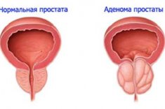 Аденома простаты и секс