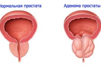 Аденома простаты и секс - No-onco.ru