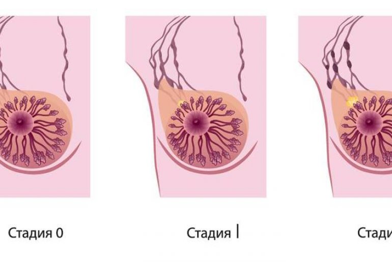 Классификация рака молочной железы