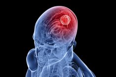 Диагностика рака мозга c помощью онкомаркеров