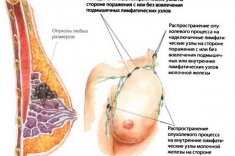 Рак груди: симптомы, виды, лечение
