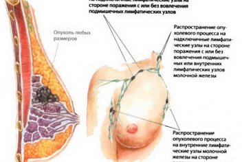 Рак груди: симптомы, виды, лечение - No-onco.ru
