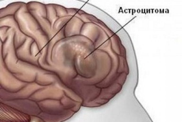Астроцитома головного мозга