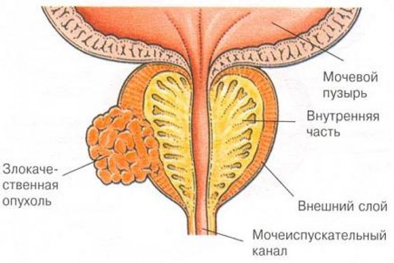 Рак простаты операция