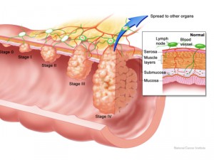 colorectal_detail_lg