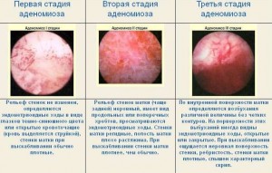 Стадии аденомиоза