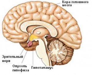 Опухоль гипофиза