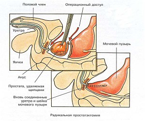 Лечение рака простаты