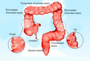 Рак сигмовидной кишки