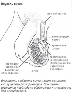 Опухоль в области яичек