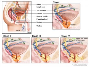Стадии рака простаты