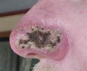 Рак носа, 4-я стадия