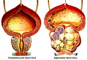 Аденома простаты