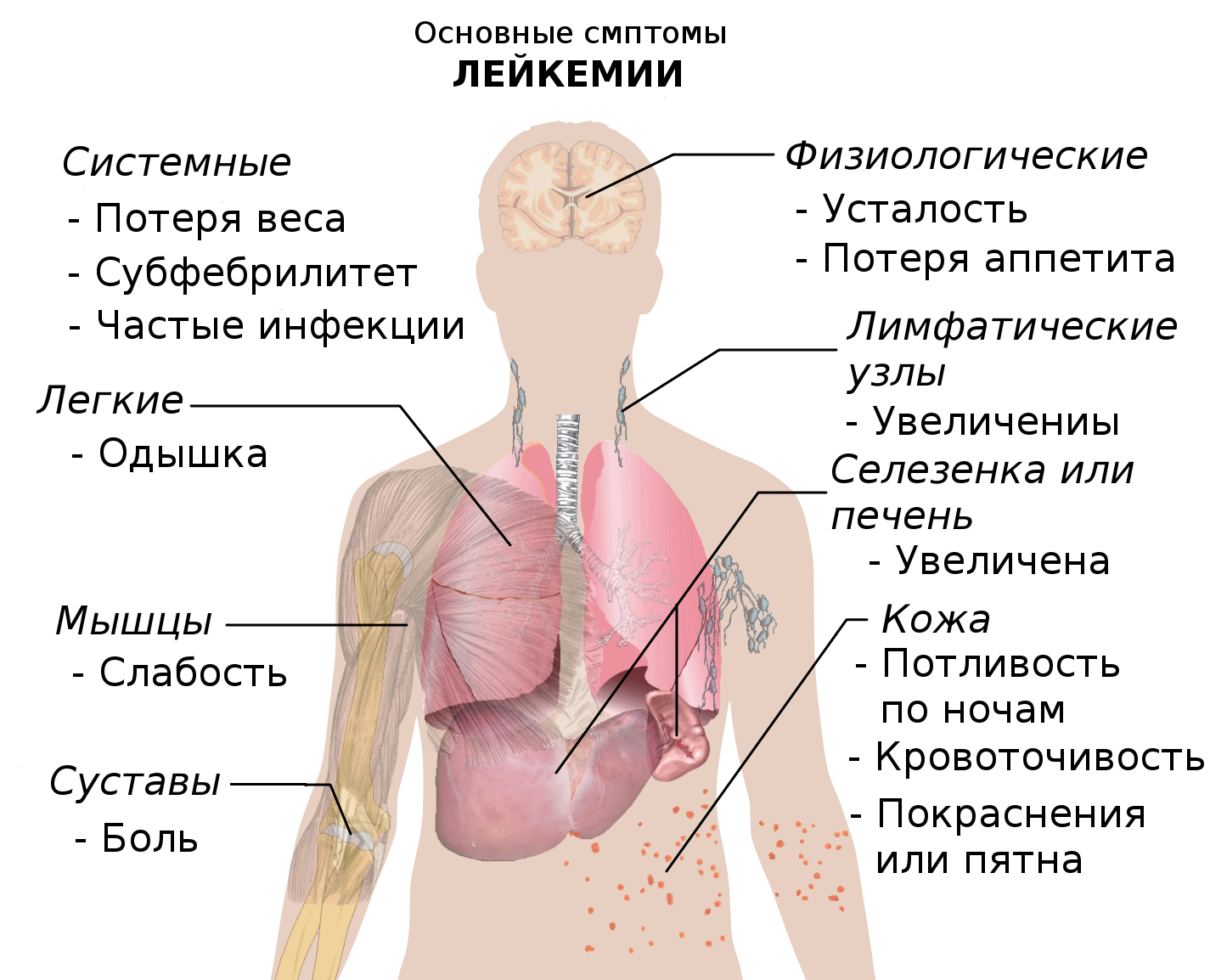 Можно излечить рак. Основные симптомы лейкемии.