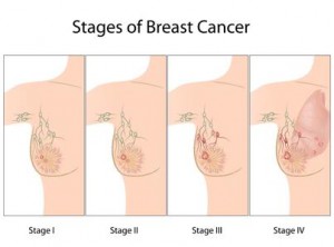 Стадии рака молочной железы