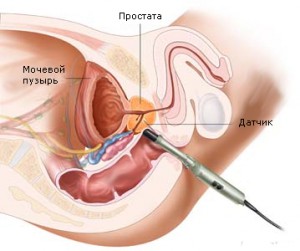 Диагностика опухолей предстательной железы