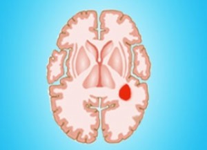 Опухоль мозга