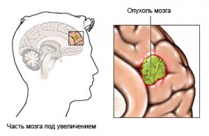 Рак головного мозга