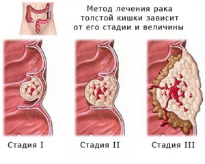 Стадии рака толстой кишки