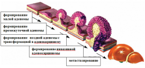Стадии рака толстого кишечника