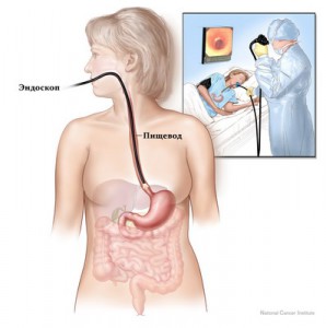 Диагностика рака пищевода