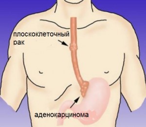 Виды рака пищевода