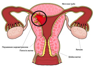 Эндометриоз матки